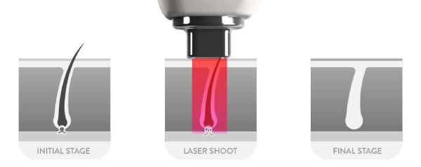 illustration de la destruction du poil par photothermolyse sélective au laser